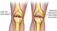 Làm thế nào khi mắc bệnh viêm khớp dạng thấp